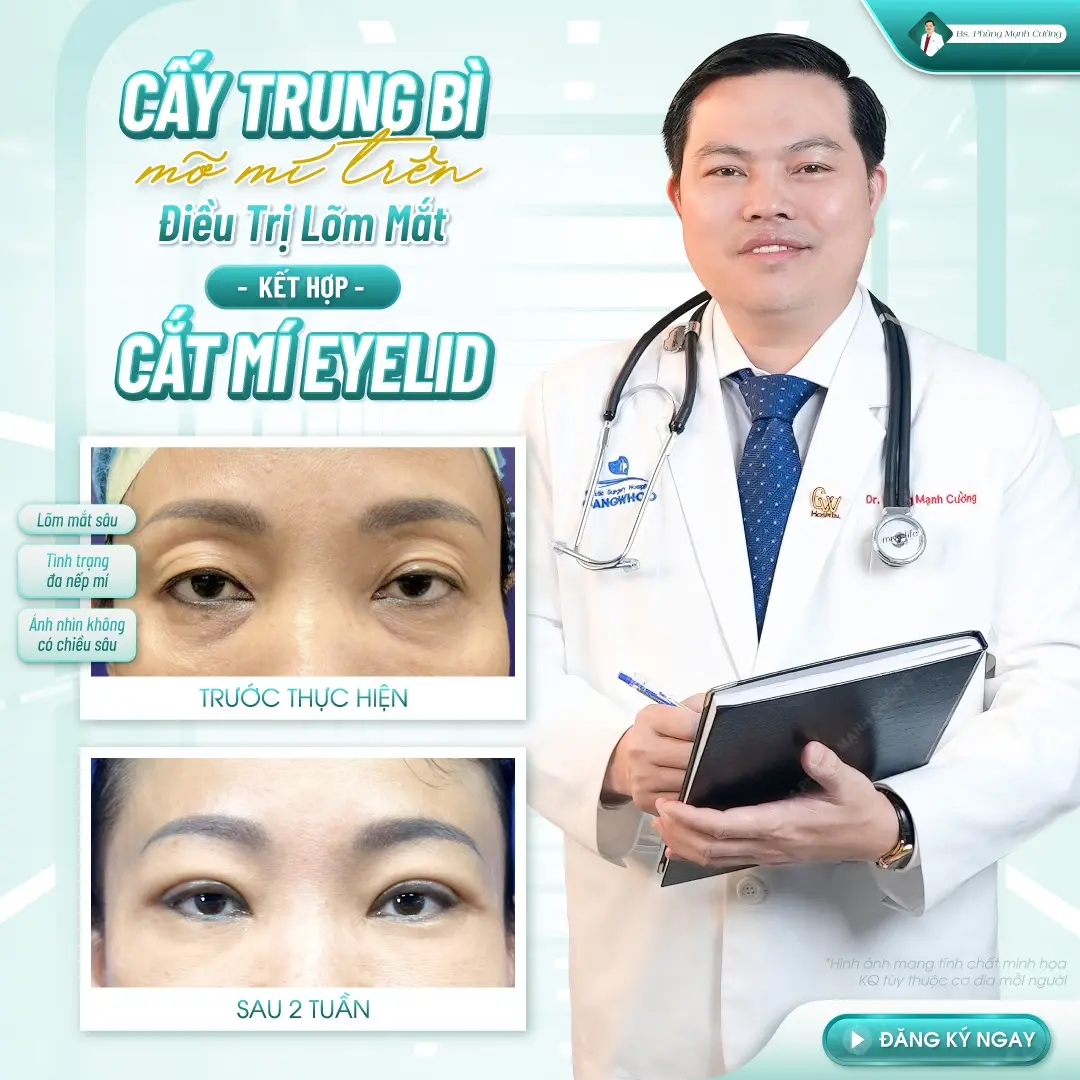 Cấy mỡ mí mắt giúp giải quyết hốc mắt sâu