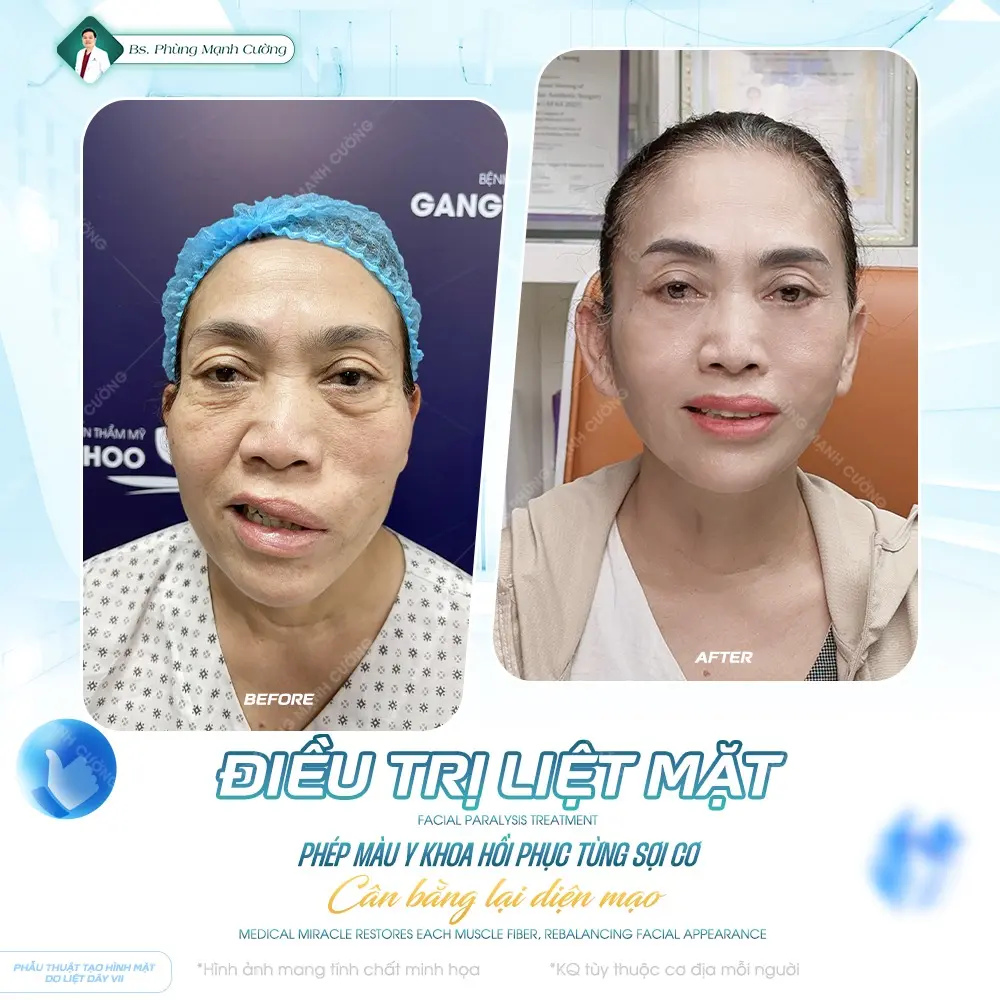 Điều trị liệt mặt lâu năm bằng phương pháp ngoại khoa
