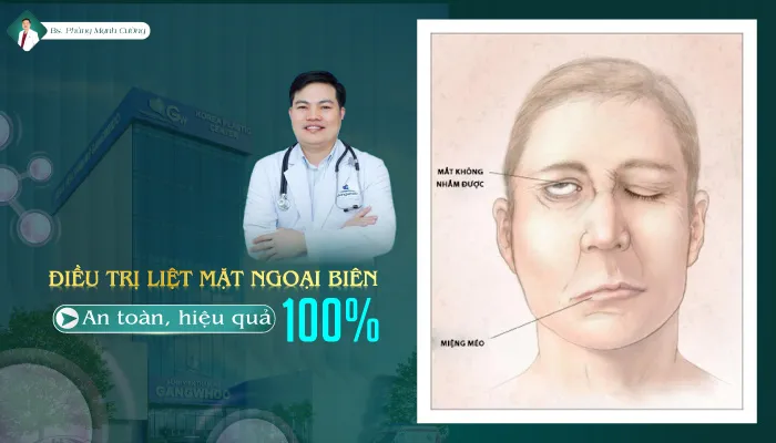 Điều trị liệt mặt ngoại biên an toàn hiệu quả