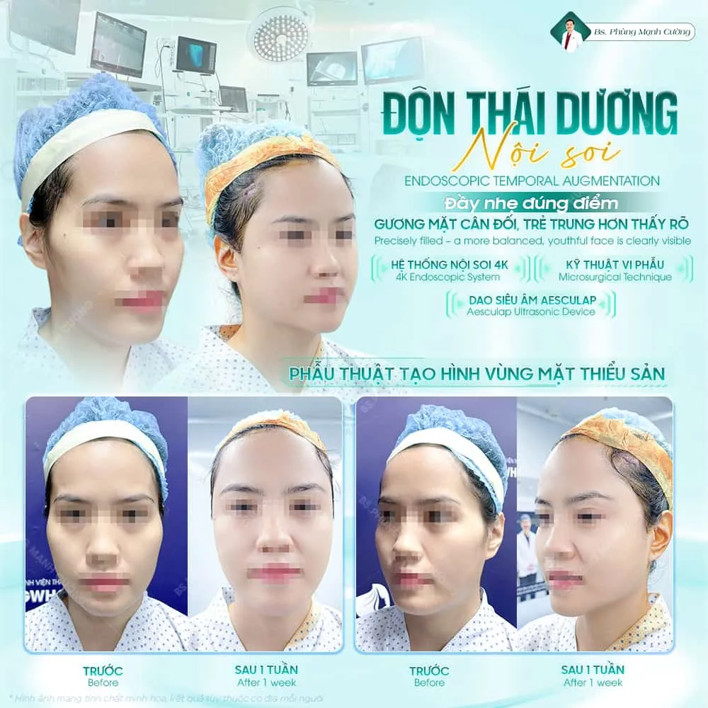 Độn thái dương an toàn và thẩm mỹ tại bác sĩ Phùng Mạnh Cường