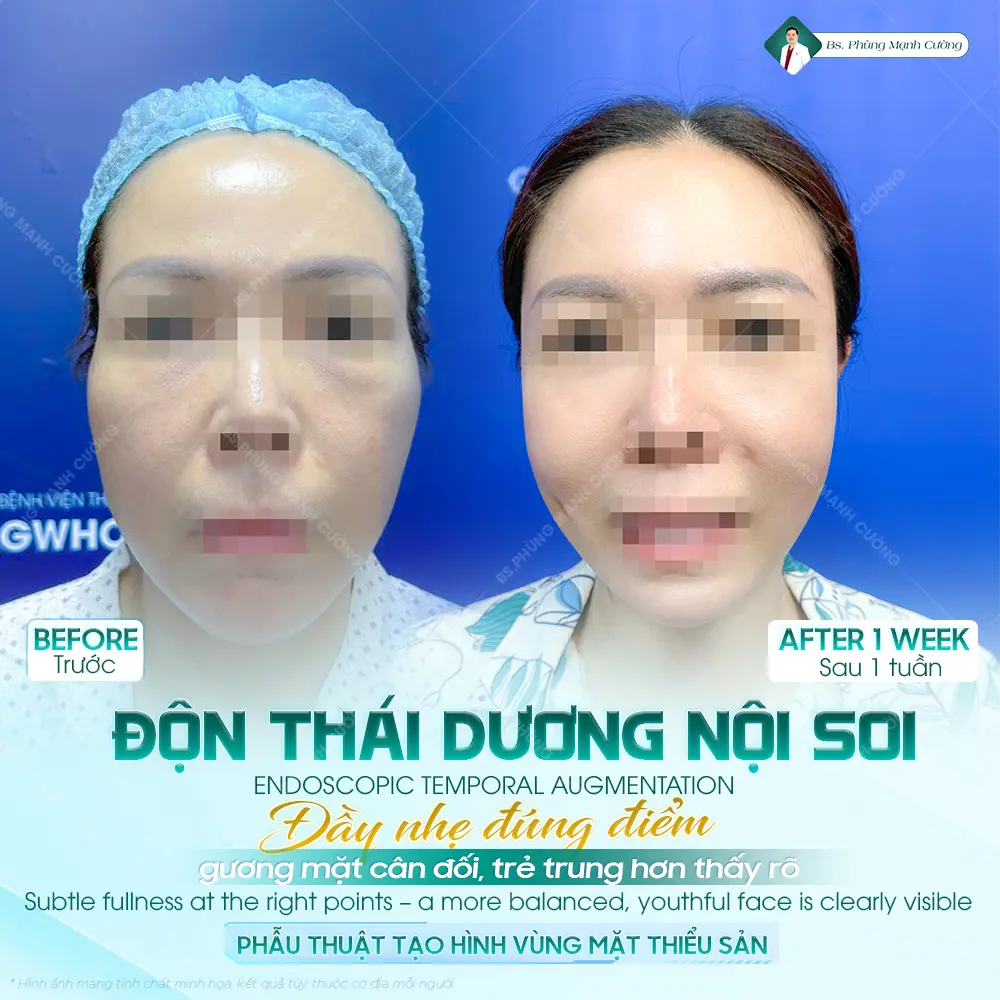 Tìm hiểu về phẫu thuật độn thái dương