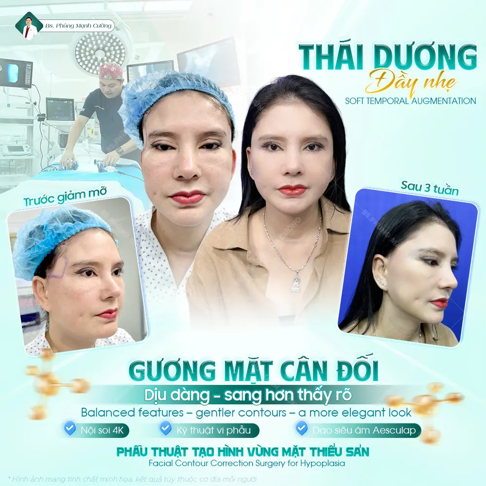 Độn thái dương sử dụng chất liệu sụn chất lượng cao