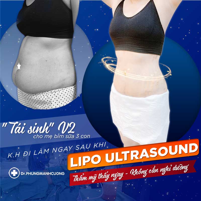 khách hàng sử dụng dịch vụ lipo ultrasound