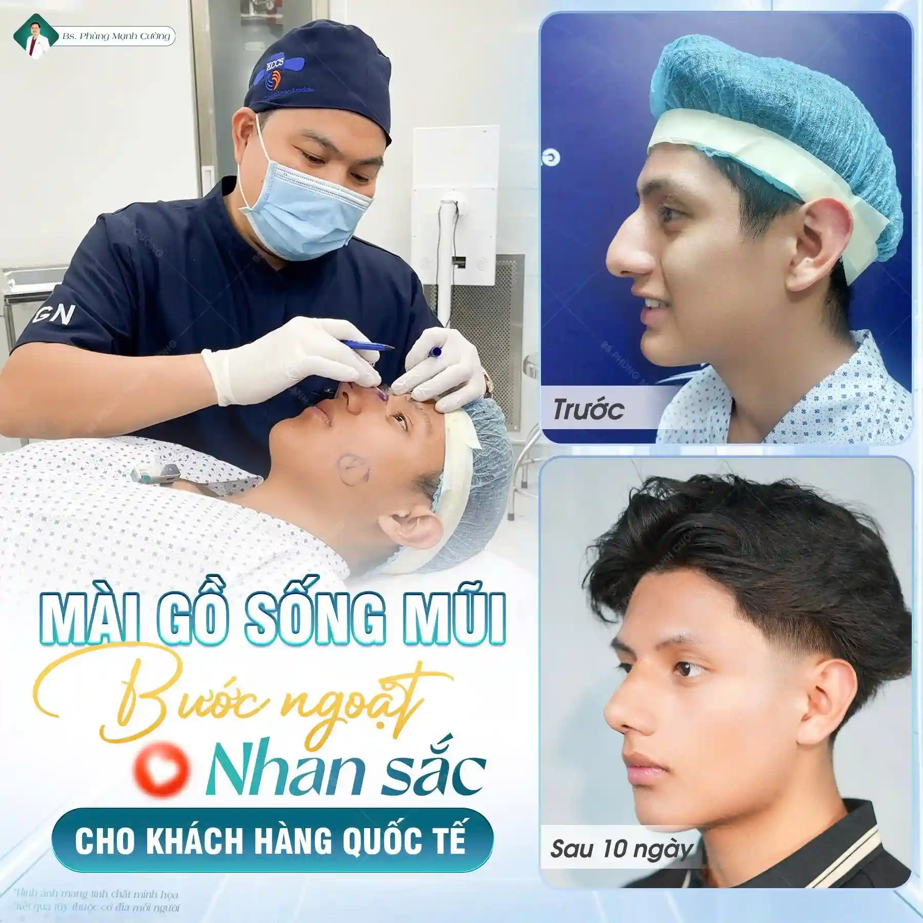 Mài gồ xương mũi rất an toàn nếu thực hiện tại cơ sở uy tín