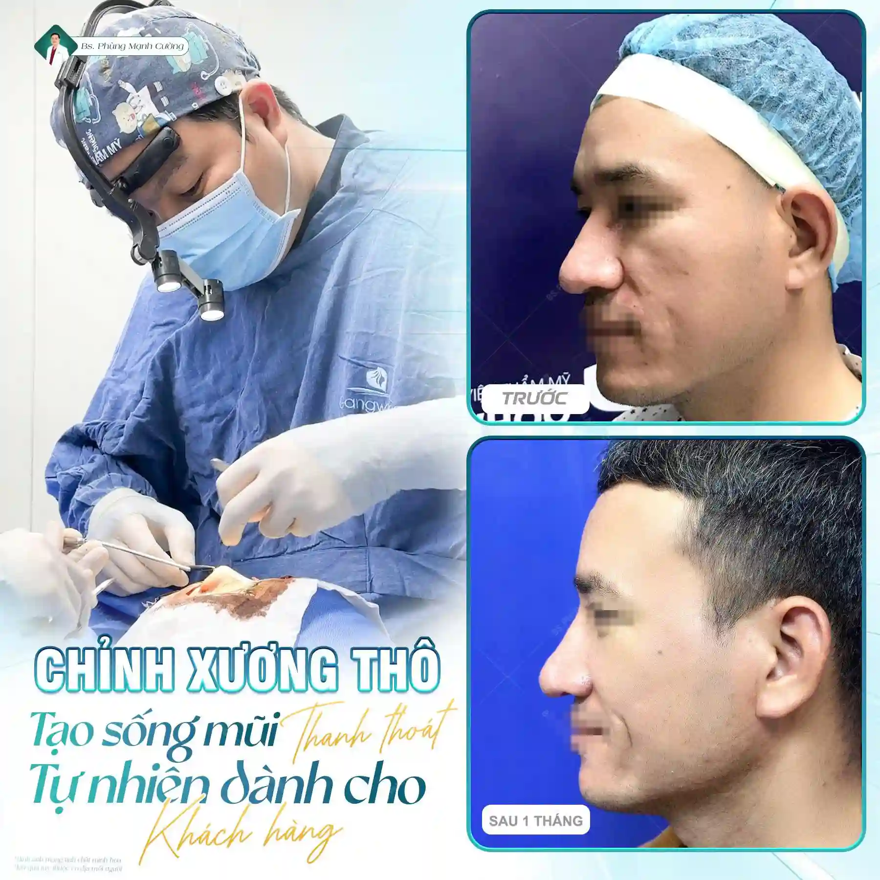 Tìm hiểu về mài gồ xương mũi