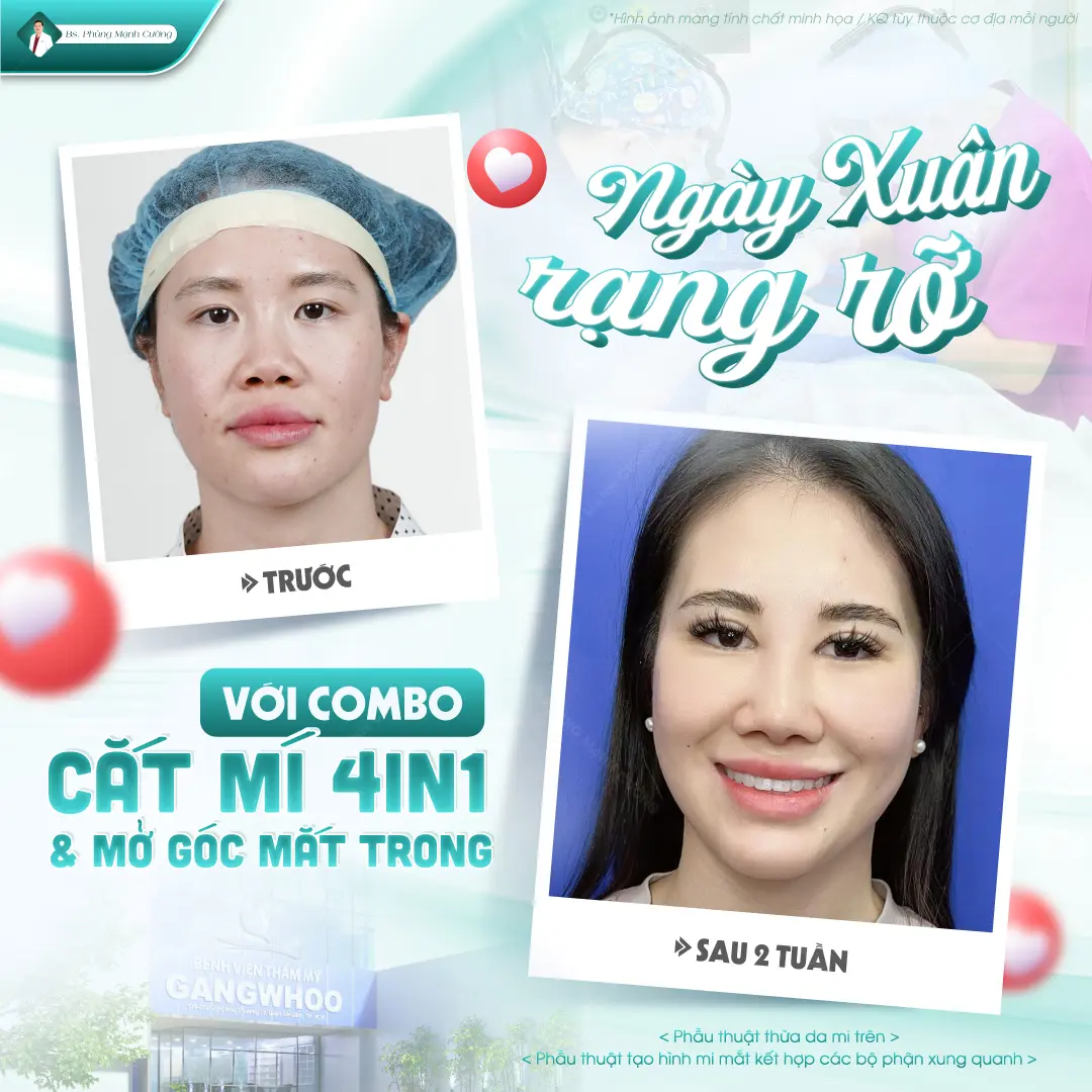 Những trường hợp nên mở rộng góc mắt