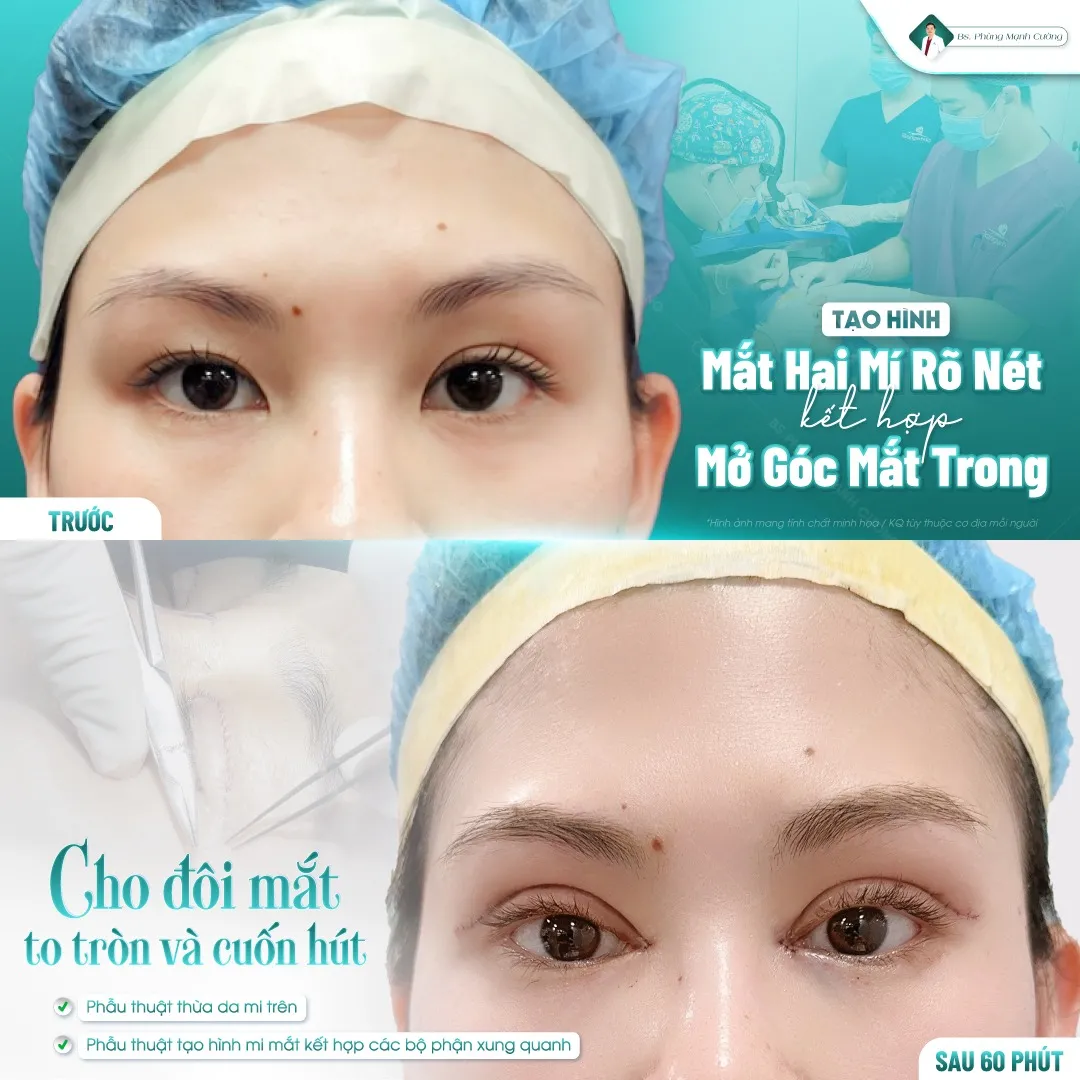 Tìm hiểu về phẫu thuật mở rộng góc mắt