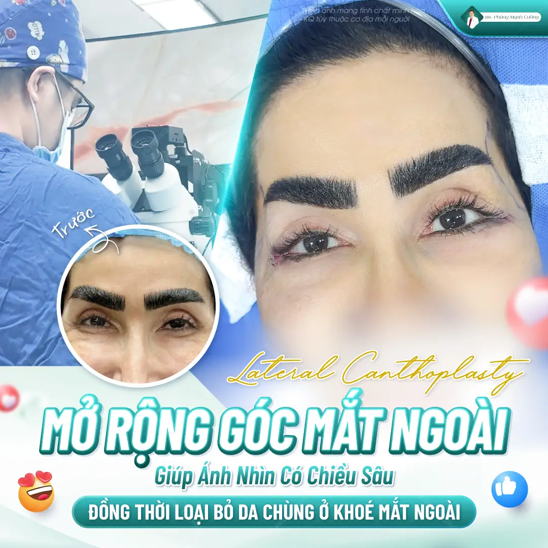 Ưu điểm của mở rộng góc mắt