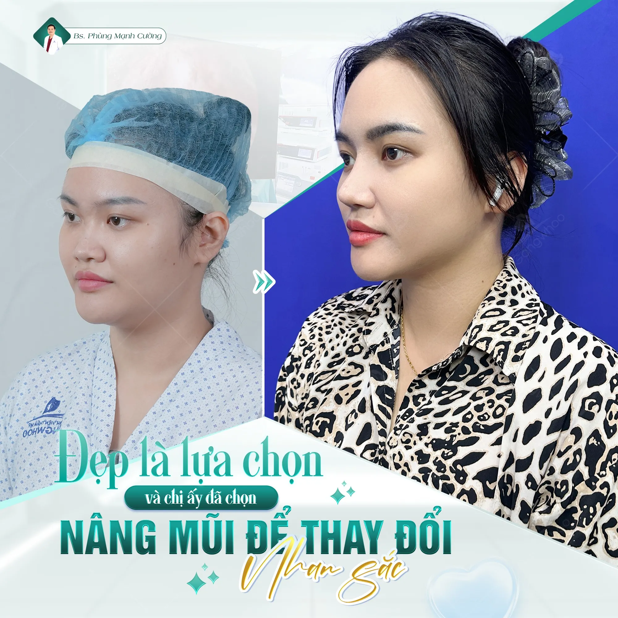 Phẫu thuật nâng mũi là gì? Chi phí và những lưu ý cần biết