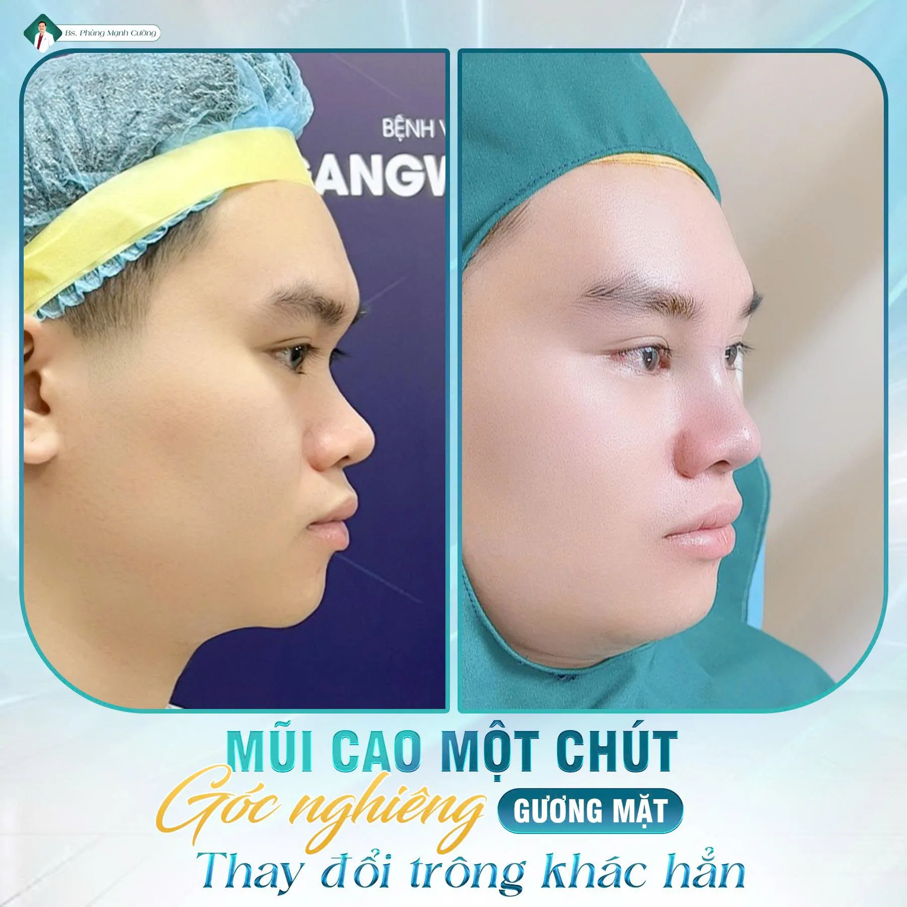 Phẫu thuật nâng mũi là gì? Chi phí và những lưu ý cần biết