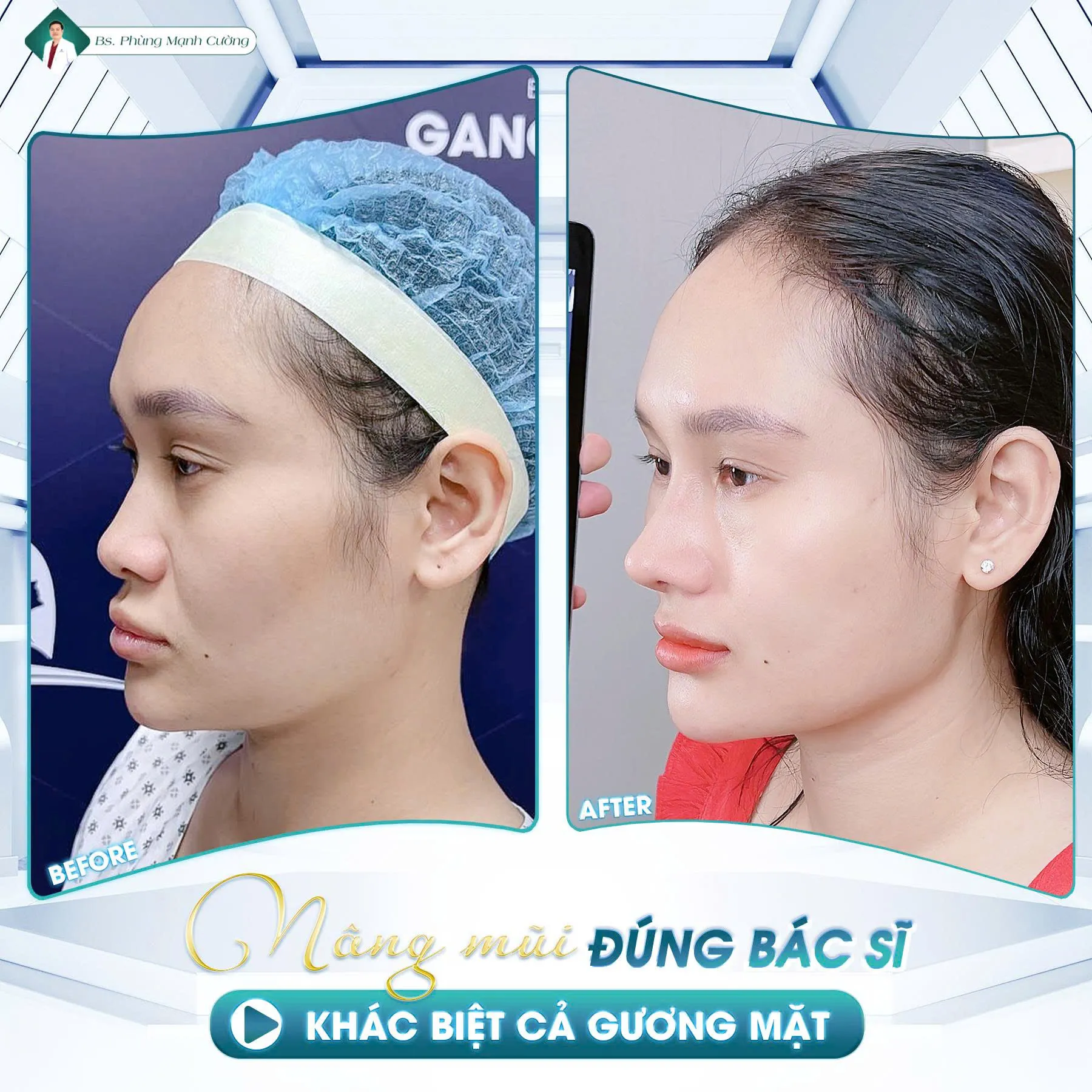 Phẫu thuật nâng mũi là gì? Chi phí và những lưu ý cần biết