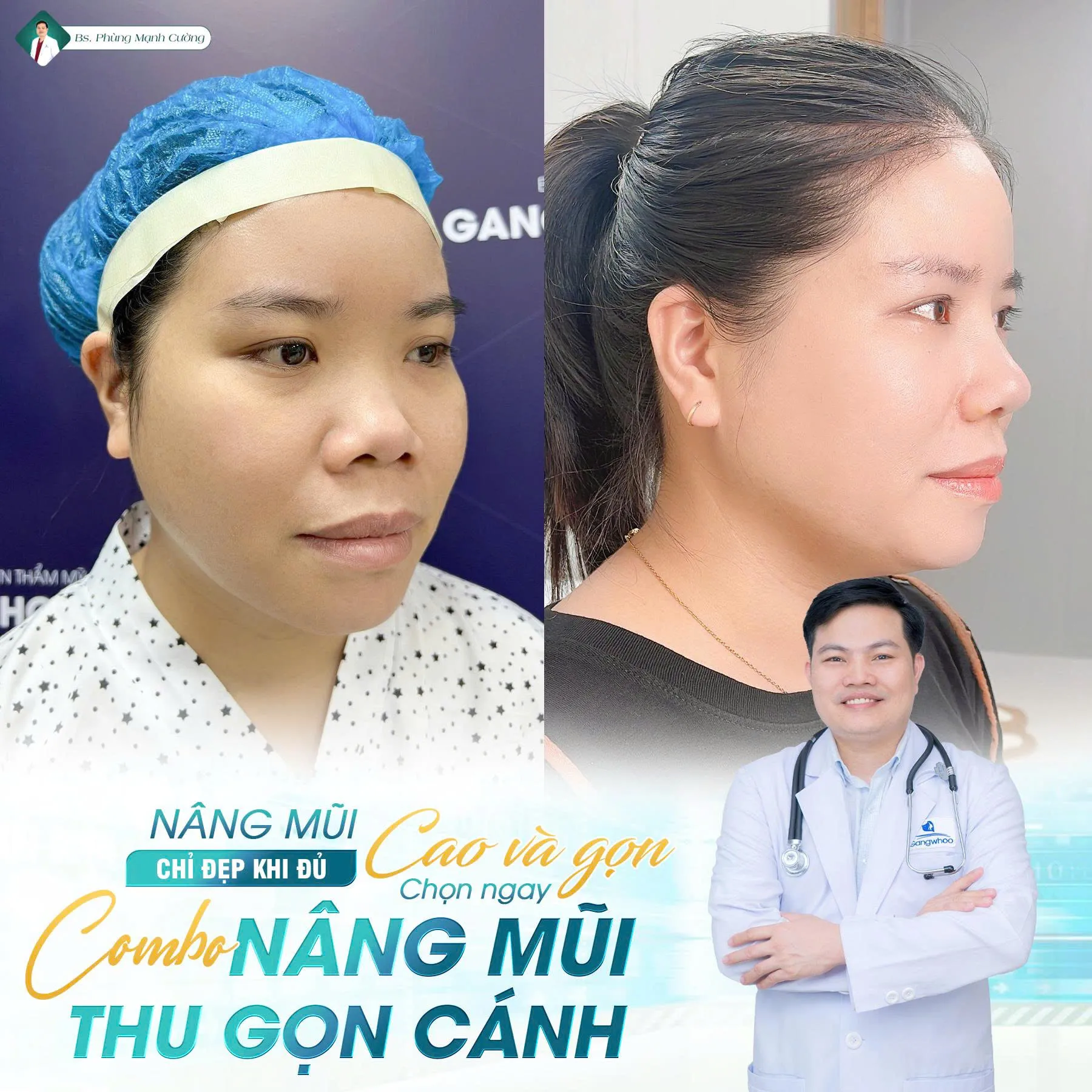 Phẫu thuật nâng mũi là gì? Chi phí và những lưu ý cần biết