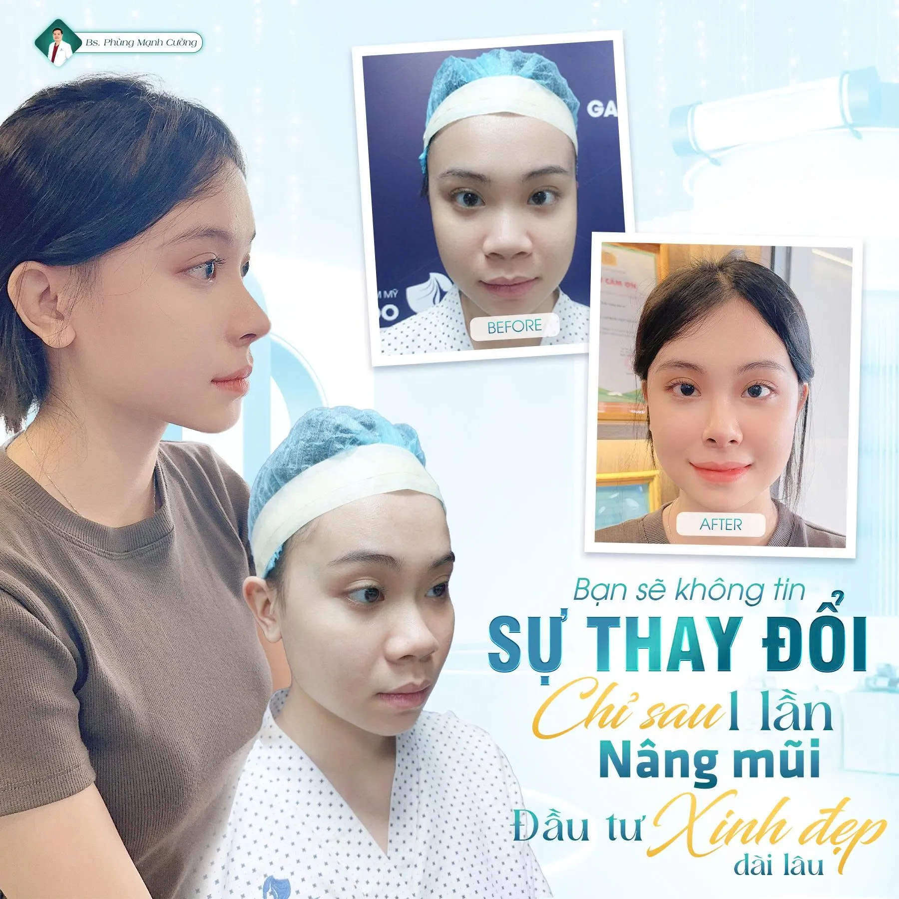 Phẫu thuật nâng mũi sụn sườn mang lại nhiều lợi ích