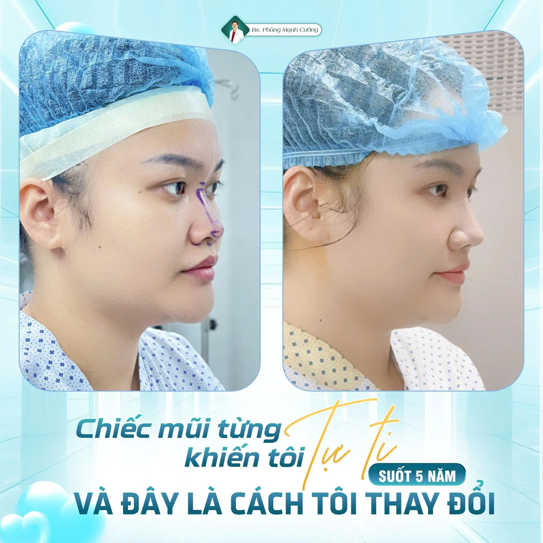 Phẫu thuật nâng mũi là gì? Chi phí và những lưu ý cần biết