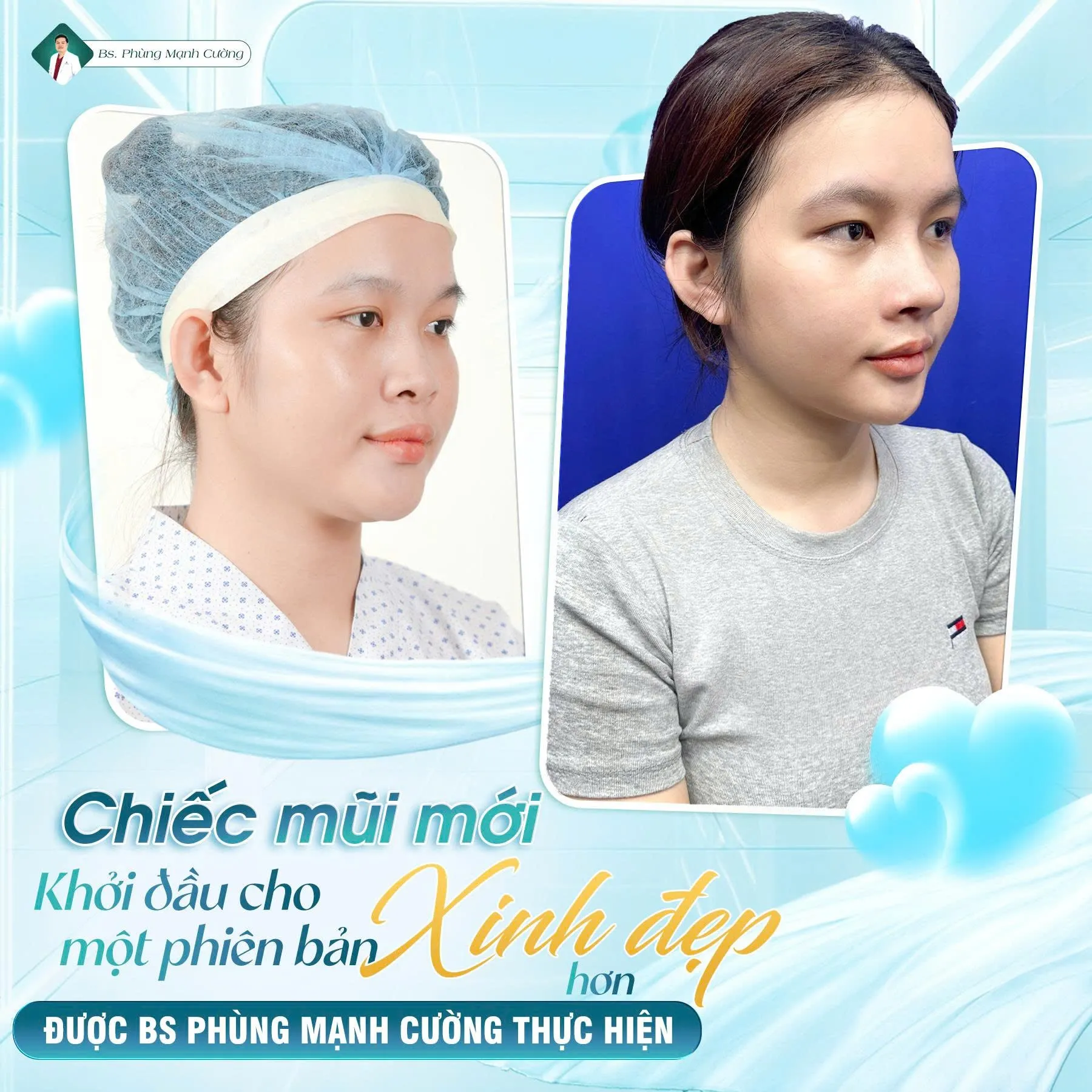 Phẫu thuật nâng mũi là gì? Chi phí và những lưu ý cần biết