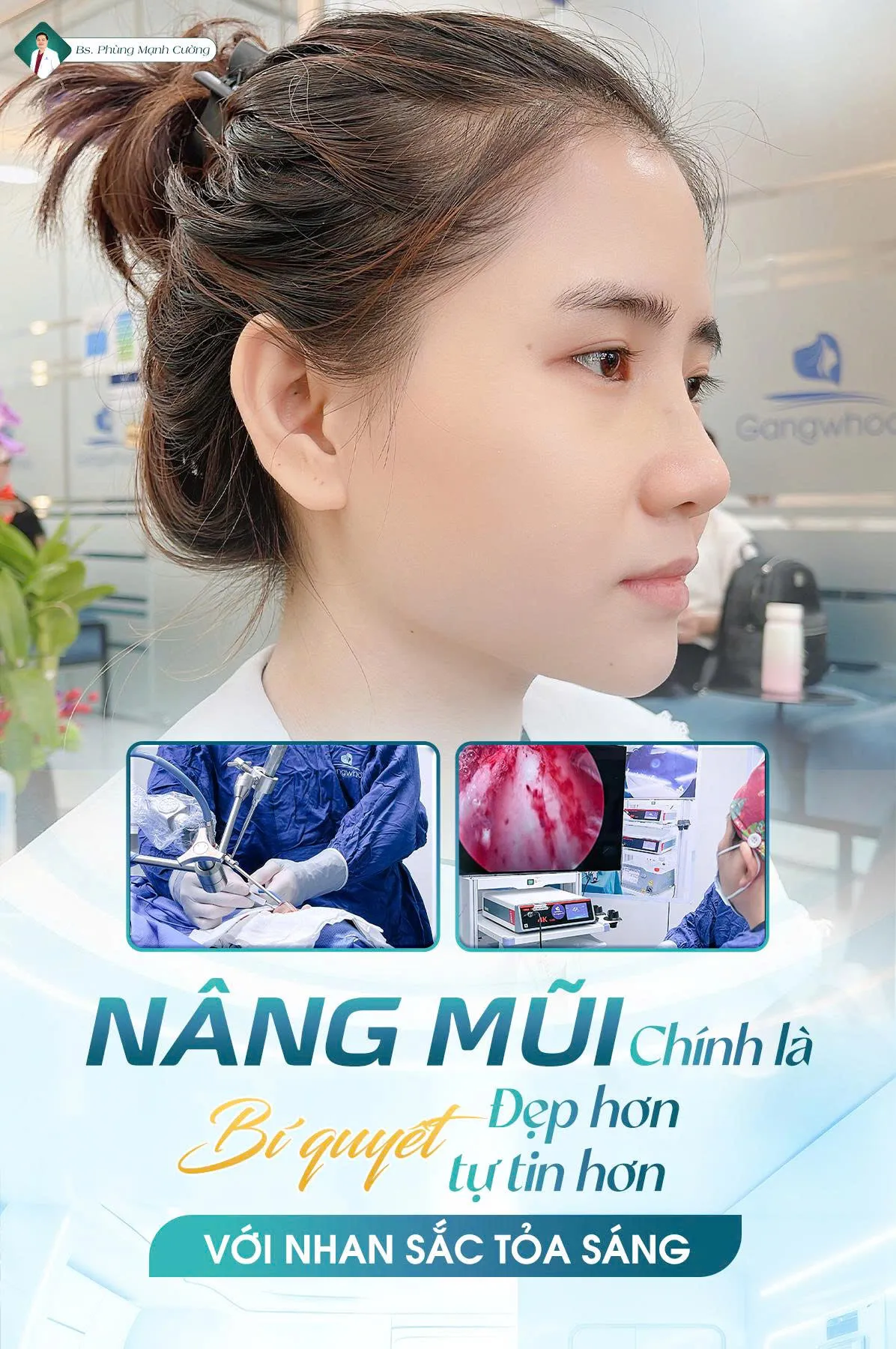 Phẫu thuật nâng mũi là gì? Chi phí và những lưu ý cần biết