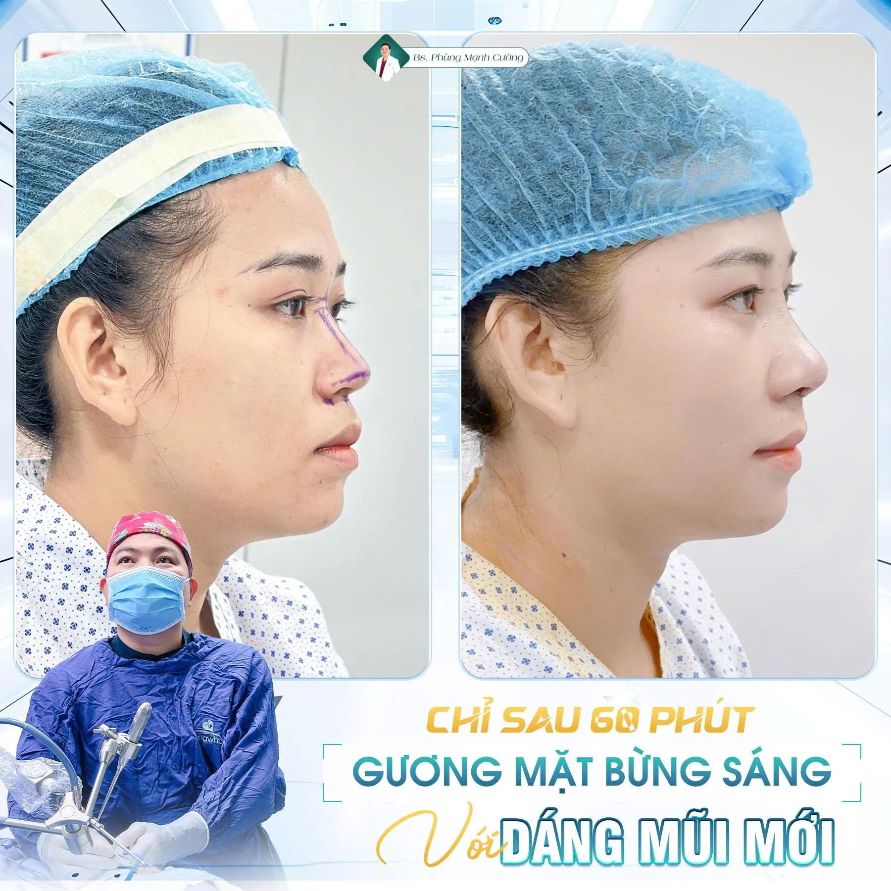 Phẫu thuật nâng mũi là gì? Chi phí và những lưu ý cần biết