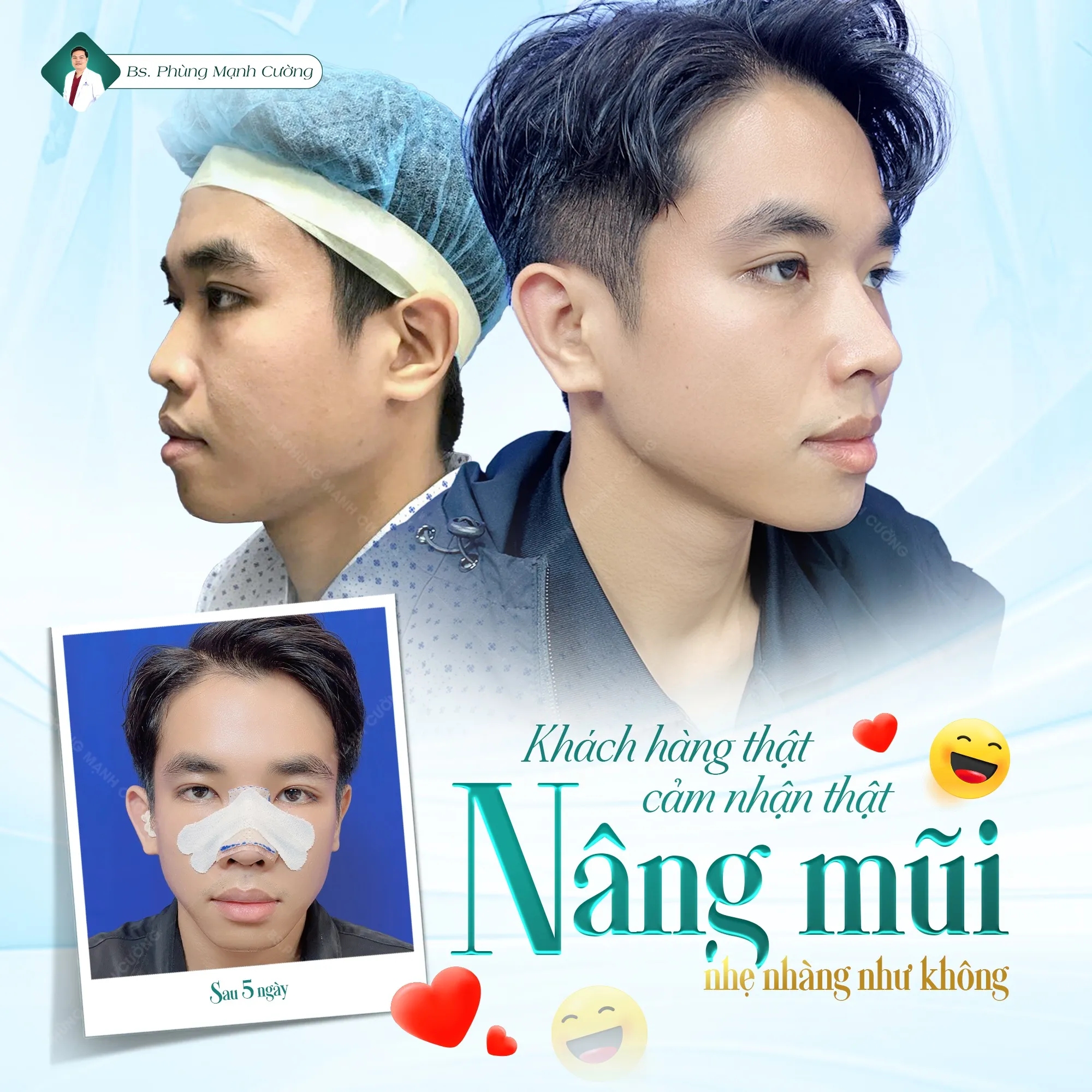 Nâng mũi Hàn Quốc có nhiều ưu điểm vượt trội