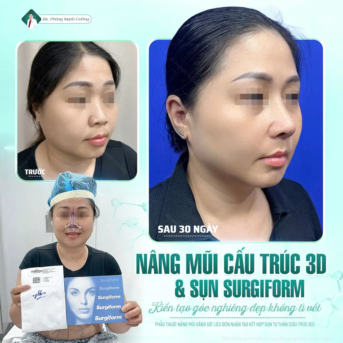 Tìm hiểu về nâng mũi surgiform