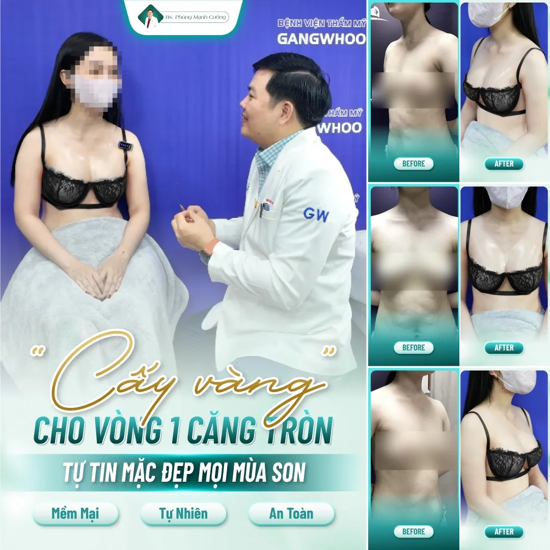 Nâng ngực bằng mỡ tự thân là gì? Có hiệu quả không? 28 Nâng Ngực Bằng Mỡ Tự Thân – Bí Quyết Vòng 1 Căng Tròn Không “Phẫu Thuật”