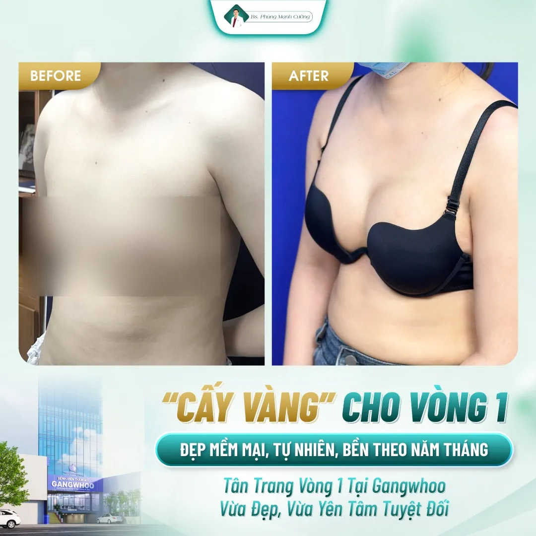 Nâng ngực bằng mỡ tự thân là gì? Có hiệu quả không? 21 Ưu Điểm Của Phương Pháp Nâng Ngực Cấy Vàng