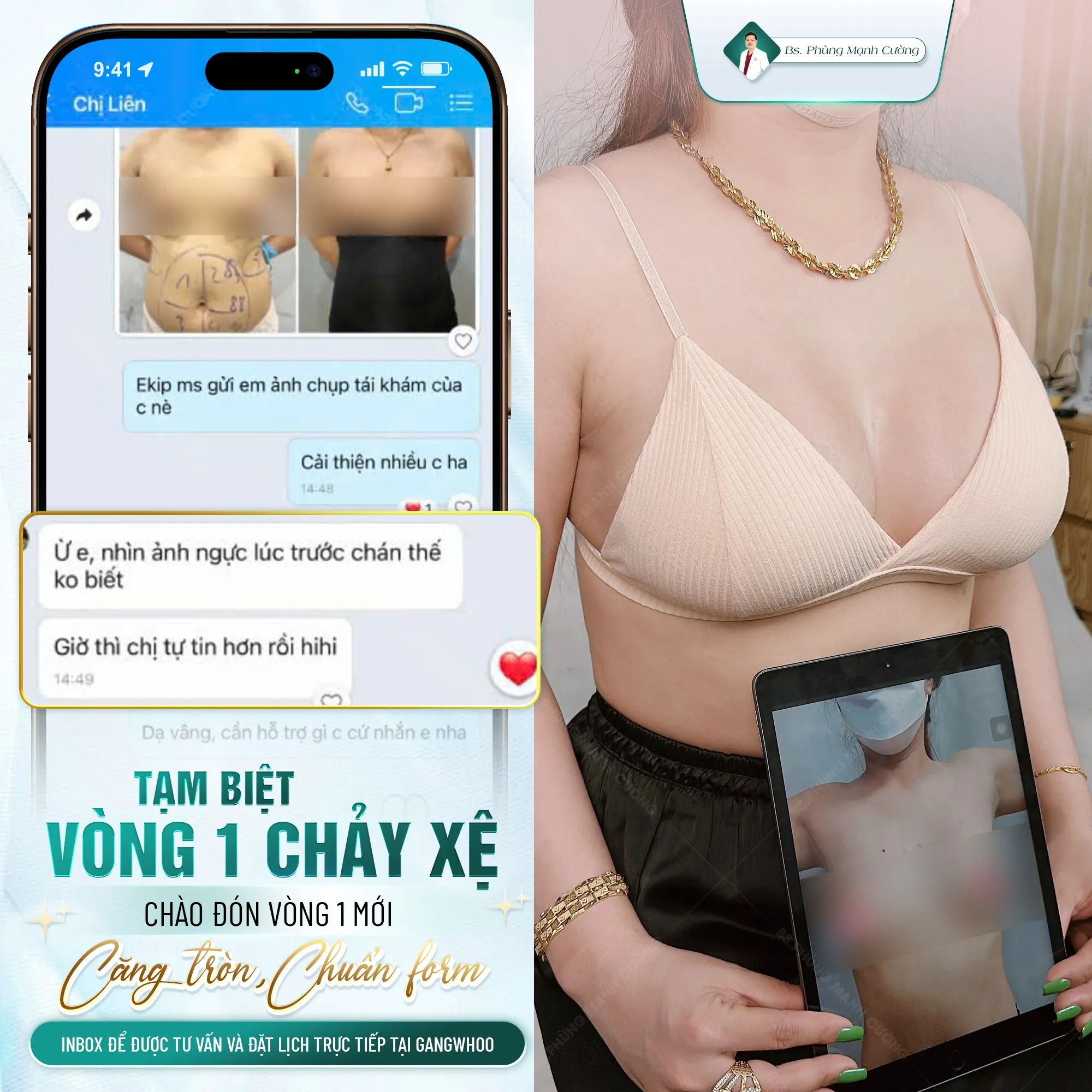 Nâng ngực bằng mỡ tự thân là gì? Có hiệu quả không? 34 Nâng Ngực Bằng Mỡ Tự Thân – Bí Quyết Vòng 1 Căng Tròn Không “Phẫu Thuật”