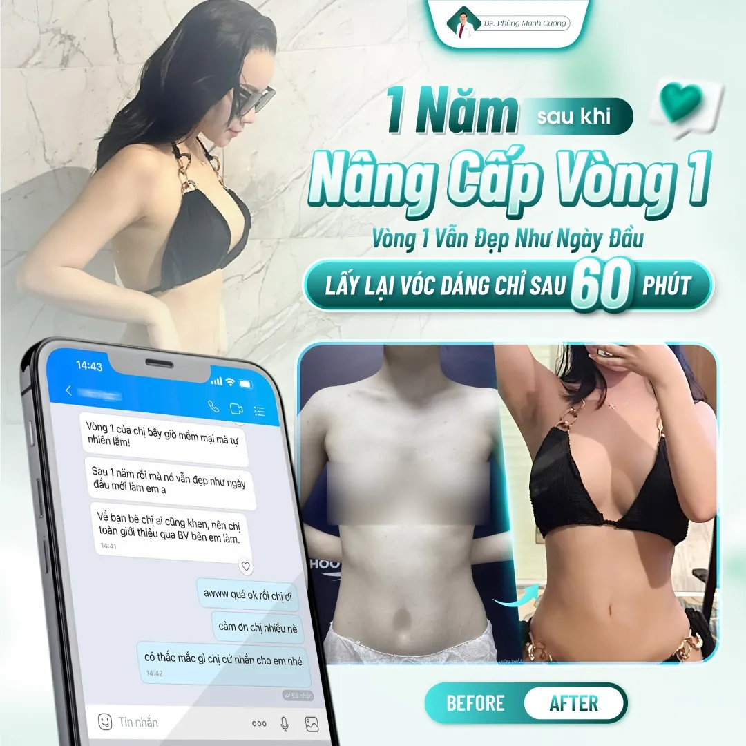 Nâng ngực bằng mỡ tự thân là gì? Có hiệu quả không? 30 Nâng Ngực Bằng Mỡ Tự Thân – Bí Quyết Vòng 1 Căng Tròn Không “Phẫu Thuật”