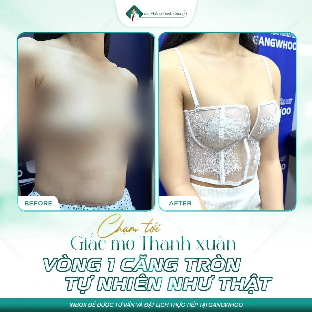 Nâng ngực bằng mỡ tự thân là gì? Có hiệu quả không? 29 Nâng Ngực Bằng Mỡ Tự Thân – Bí Quyết Vòng 1 Căng Tròn Không “Phẫu Thuật”