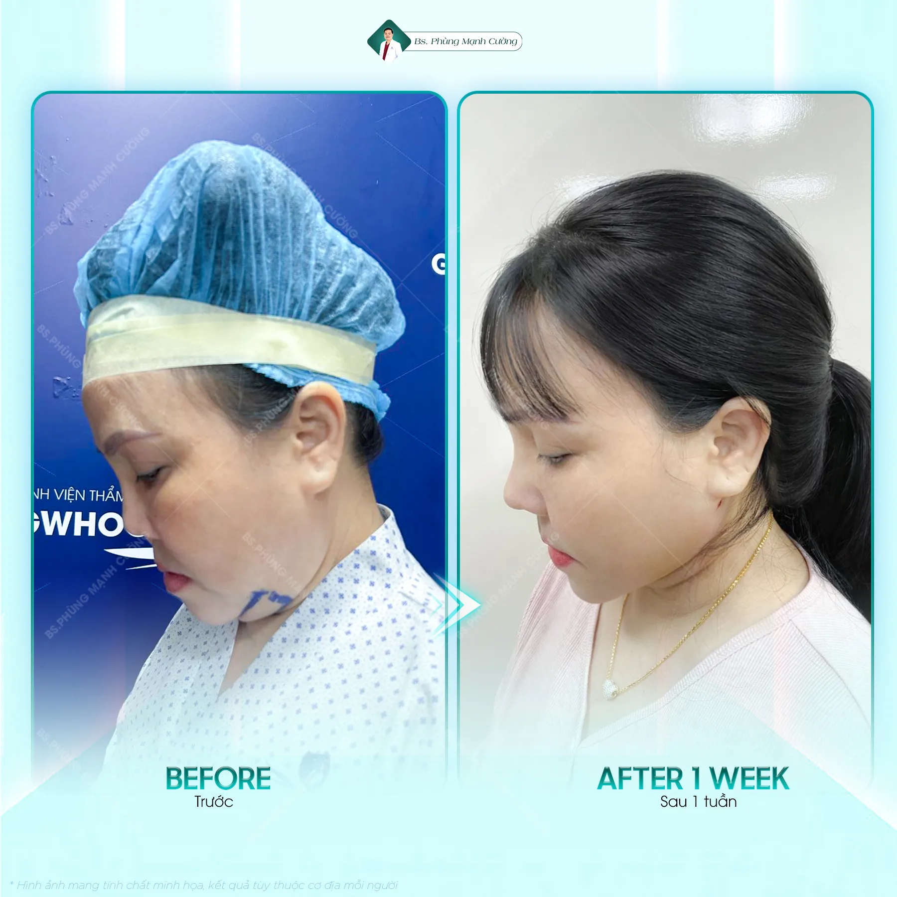 Tuân thủ chăm sóc hậu phẫu đúng cách để mũi nhanh vào form