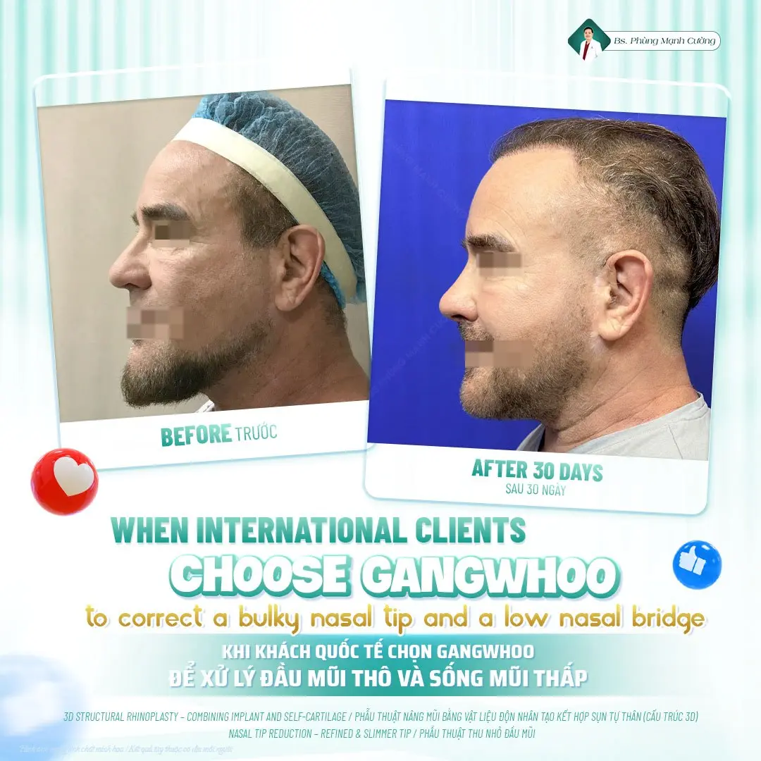 Phẫu thuật nâng mũi là gì? Chi phí và những lưu ý cần biết