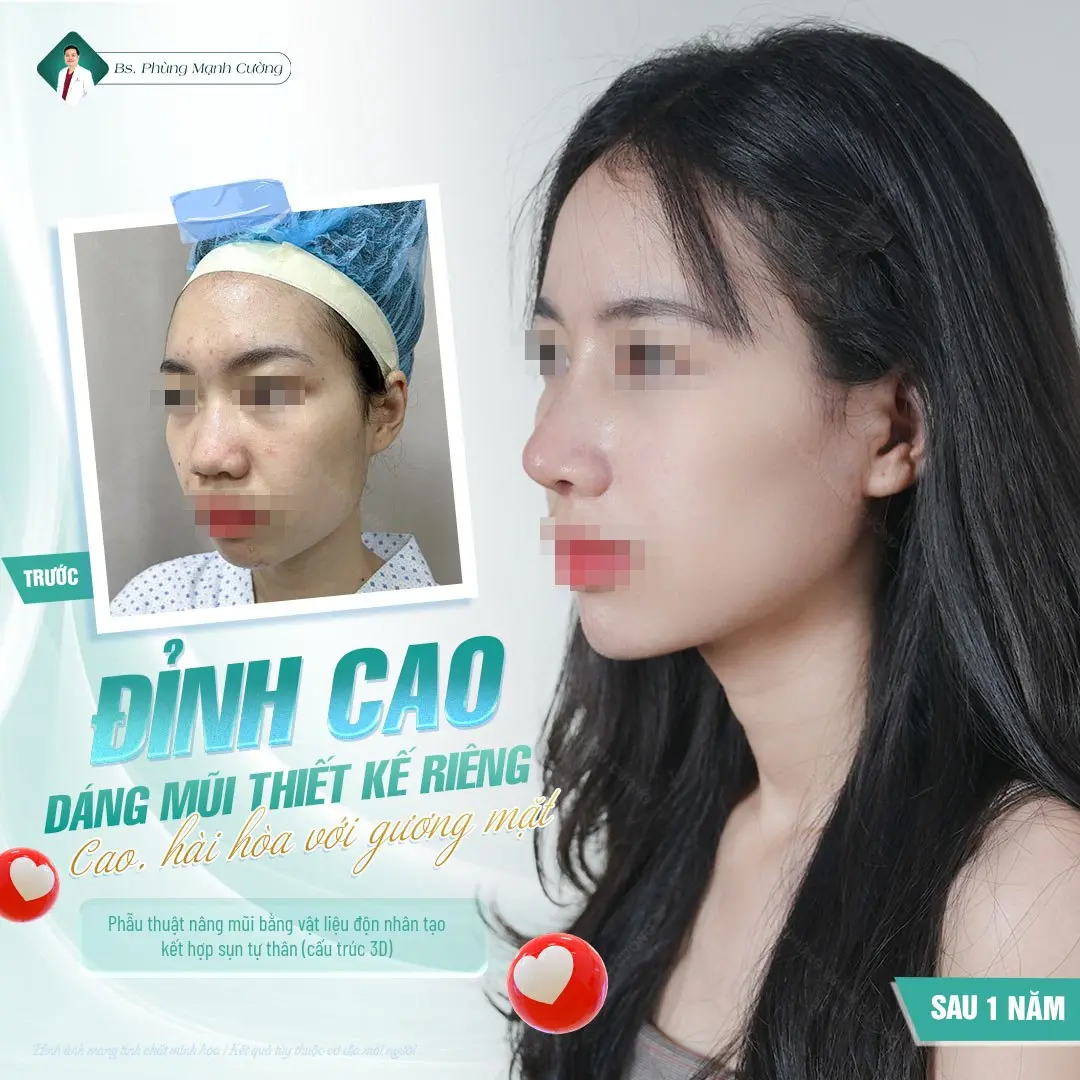 Phẫu thuật nâng mũi cấu trúc tạo dáng mũi đẹp toàn diện