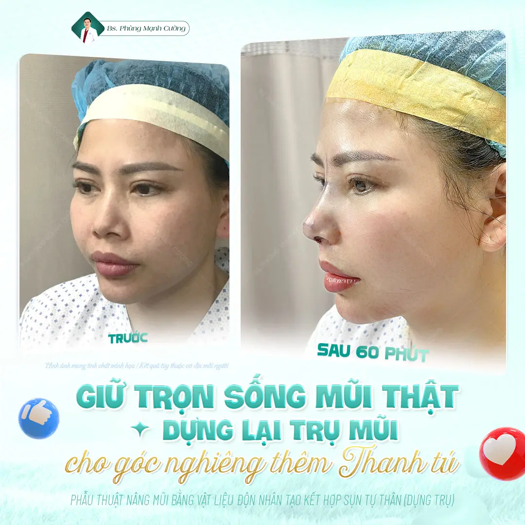 Phẫu thuật sửa mũi hỏng, khắc phục các biến chứng do lần sửa mũi trước đó