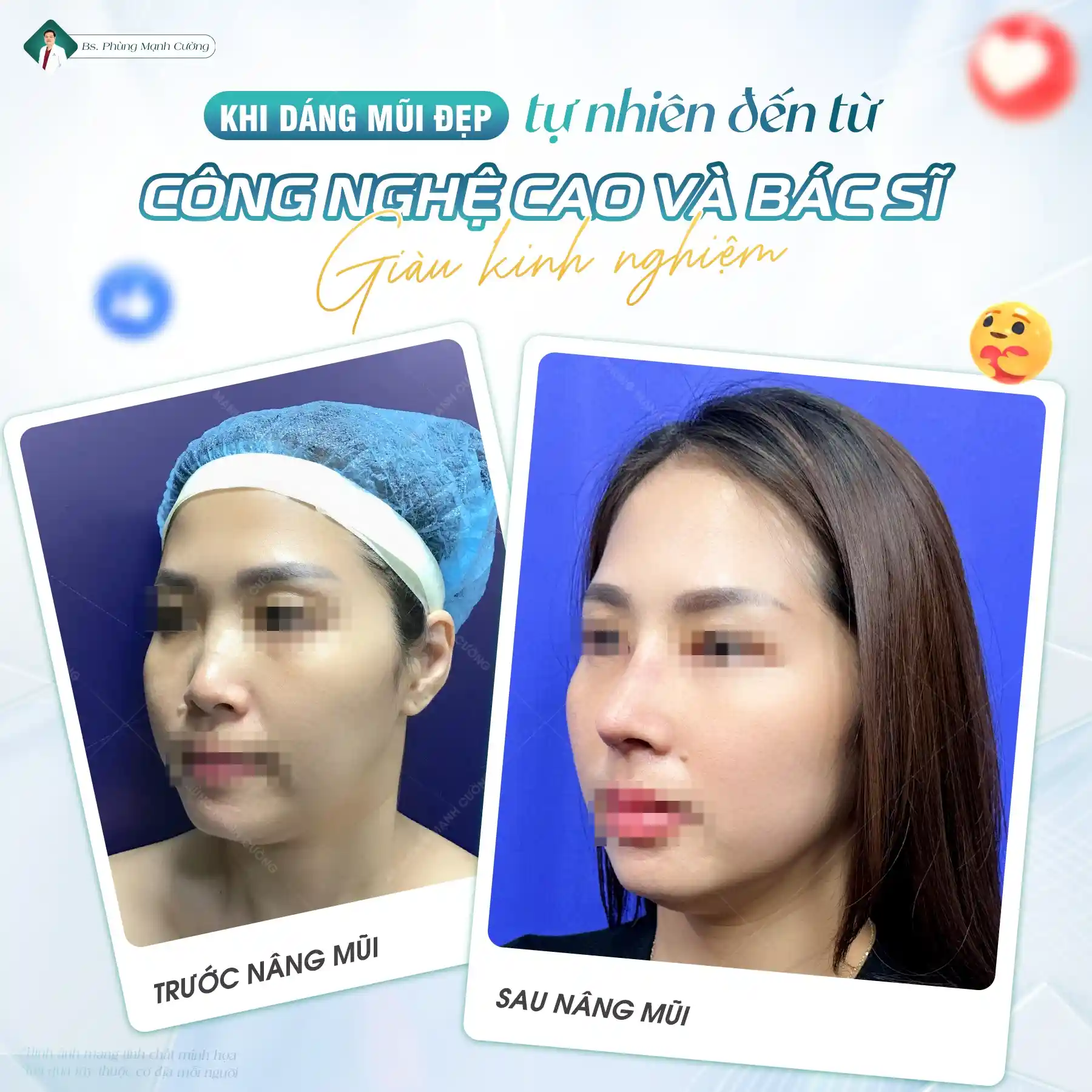 Phẫu thuật nâng mũi là gì? Chi phí và những lưu ý cần biết