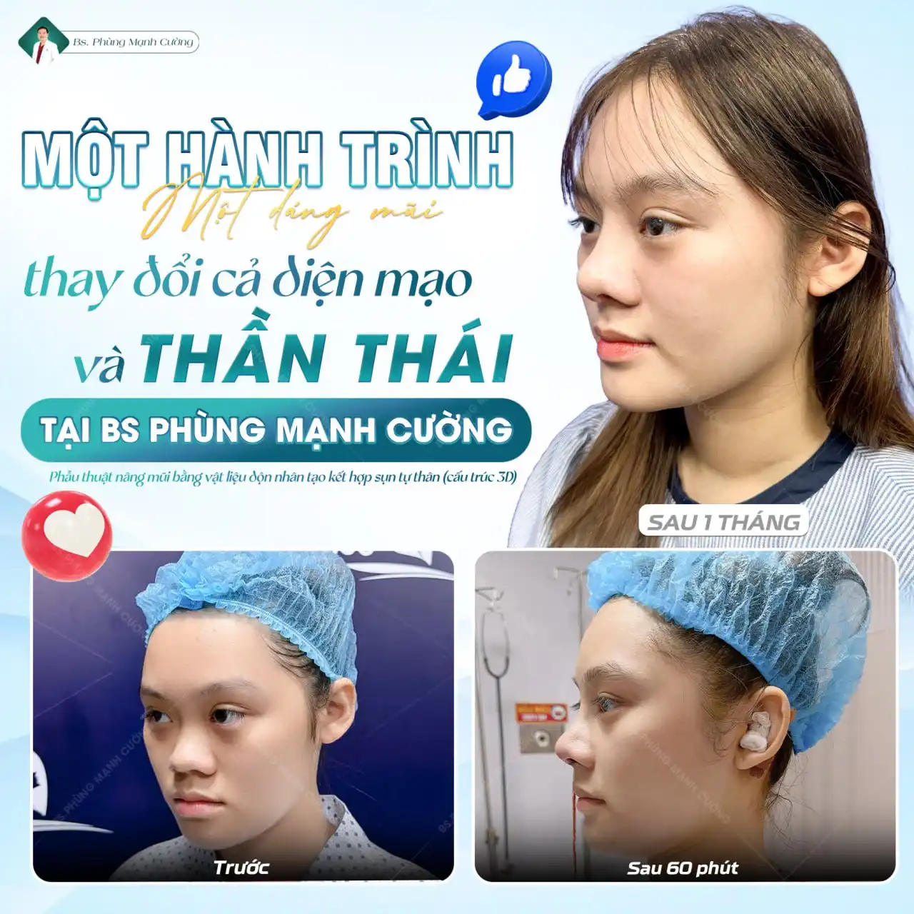 Phẫu thuật nâng mũi là gì? Chi phí và những lưu ý cần biết