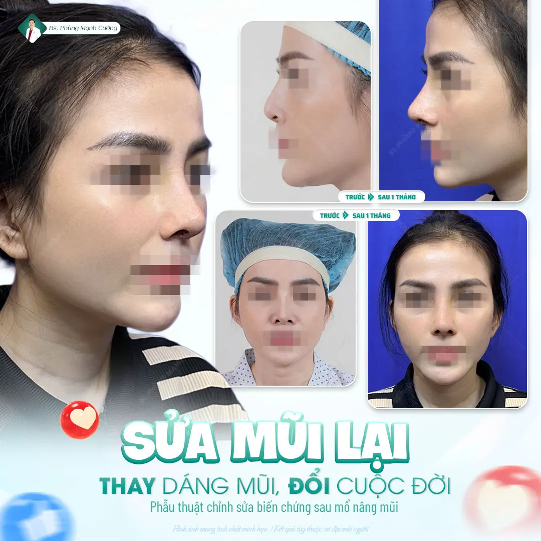 Phẫu thuật nâng mũi là gì? Chi phí và những lưu ý cần biết