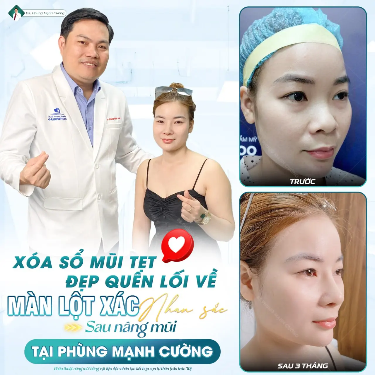 Phẫu thuật nâng mũi là gì? Chi phí và những lưu ý cần biết