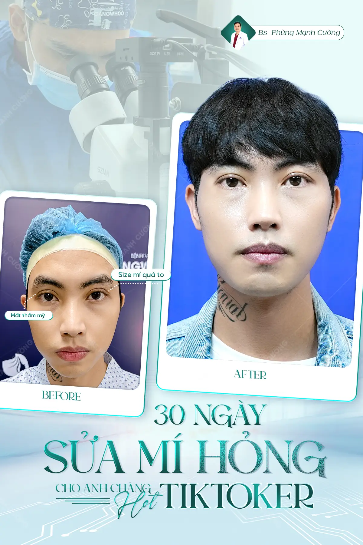Cắt mí bị hỏng: Nguyên nhân, dấu hiệu và cách khắc phục 24 30 ngày sau khi sửa mí hỏng cho anh chàng hot tiktoker