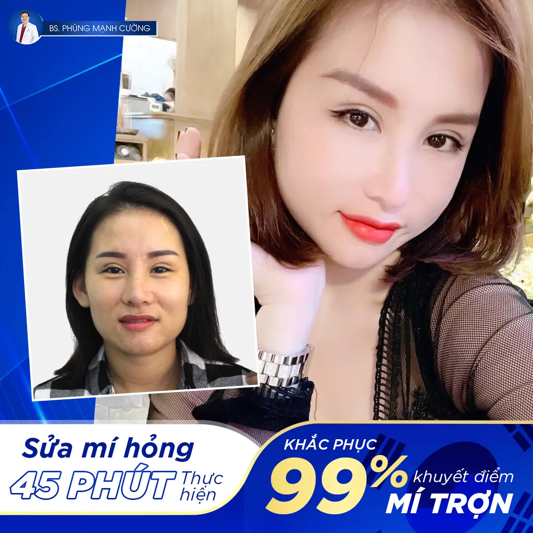 Cắt mí bị hỏng: Nguyên nhân, dấu hiệu và cách khắc phục 25 Chỉ 45 phút sửa mí hỏng - Khắc phục 99% khuyết điểm mí trợn