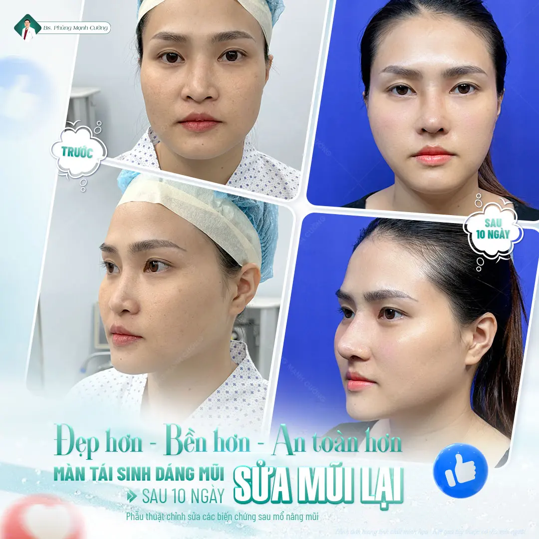 Sửa mũi hỏng khắc phục các biến chứng do nâng mũi trước đó