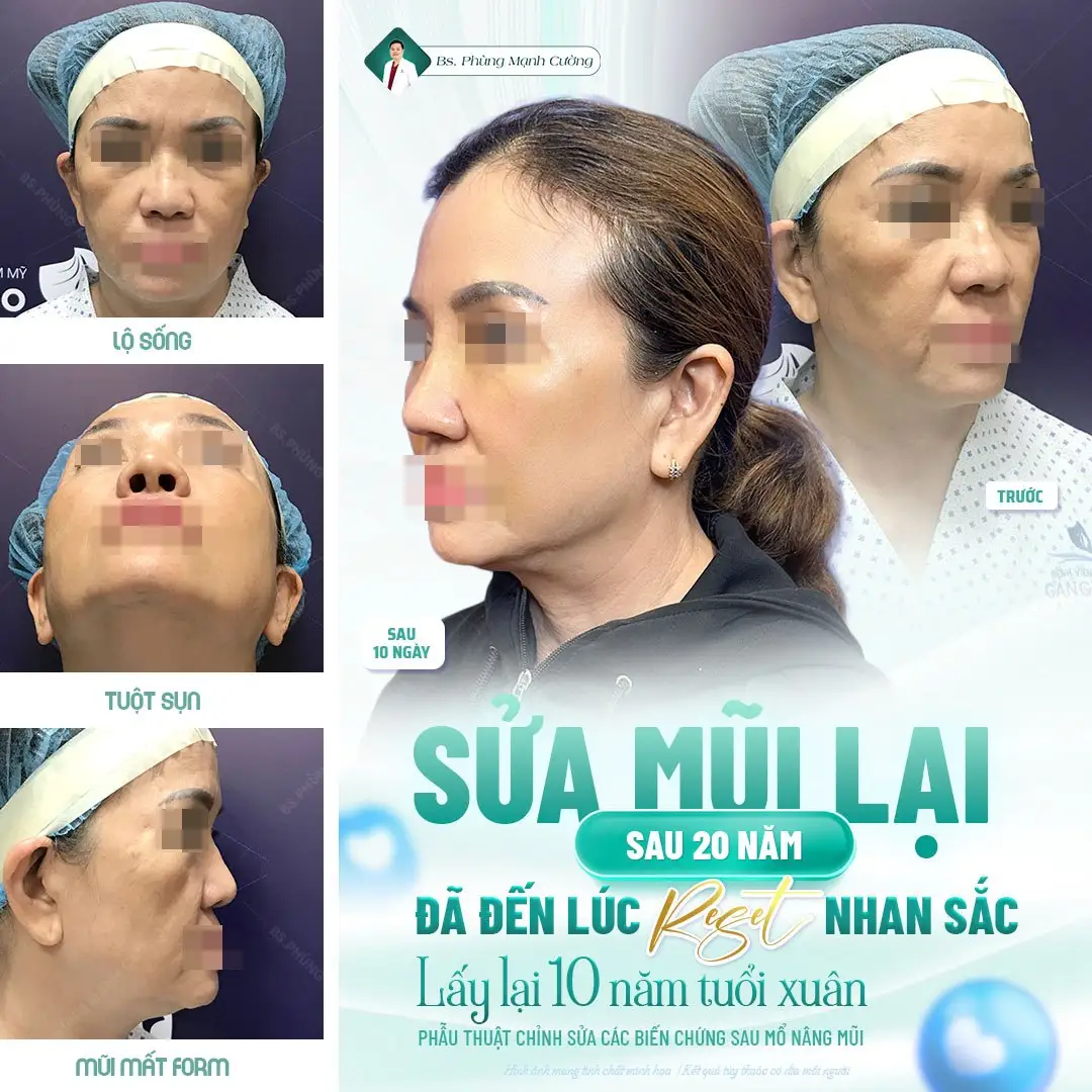 Sửa lại mũi bị lộ sống sau 20 năm