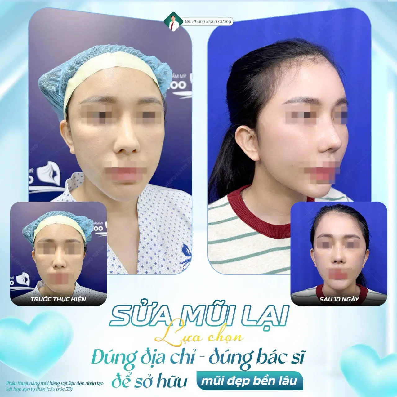 Sửa Mũi Hỏng: Khắc Phục Mũi Bị Biến Dạng, Phục Hồi Tự Nhiên