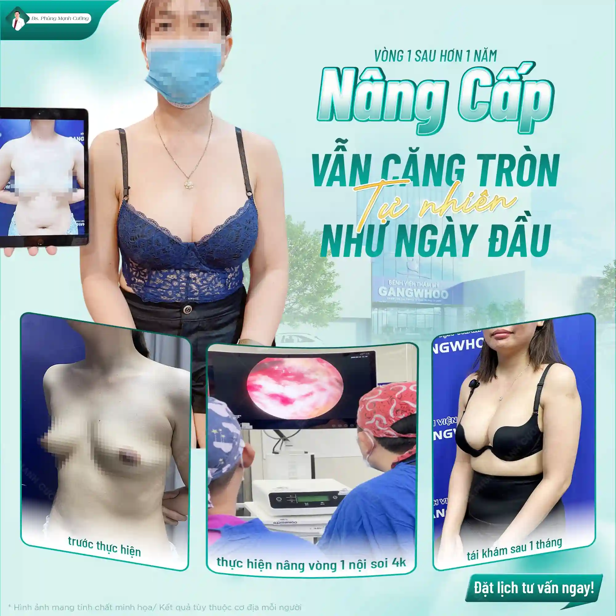 Treo ngực qua đường mổ quanh quầng vú đảm bảo an toàn