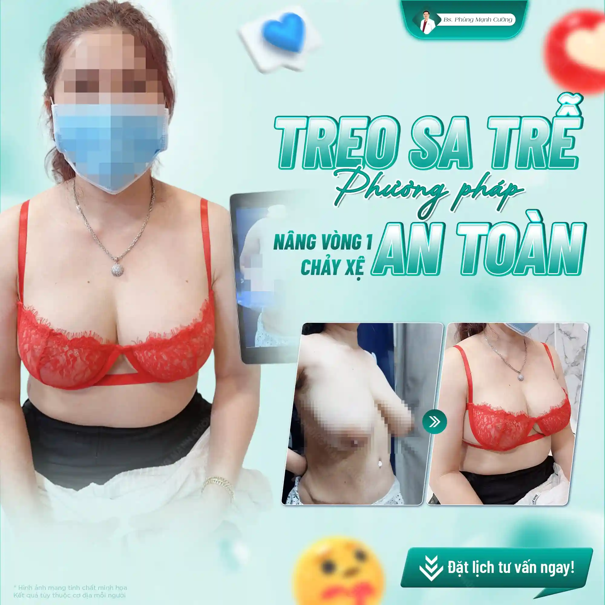 Tìm hiểu về phương pháp treo ngực sa trễ