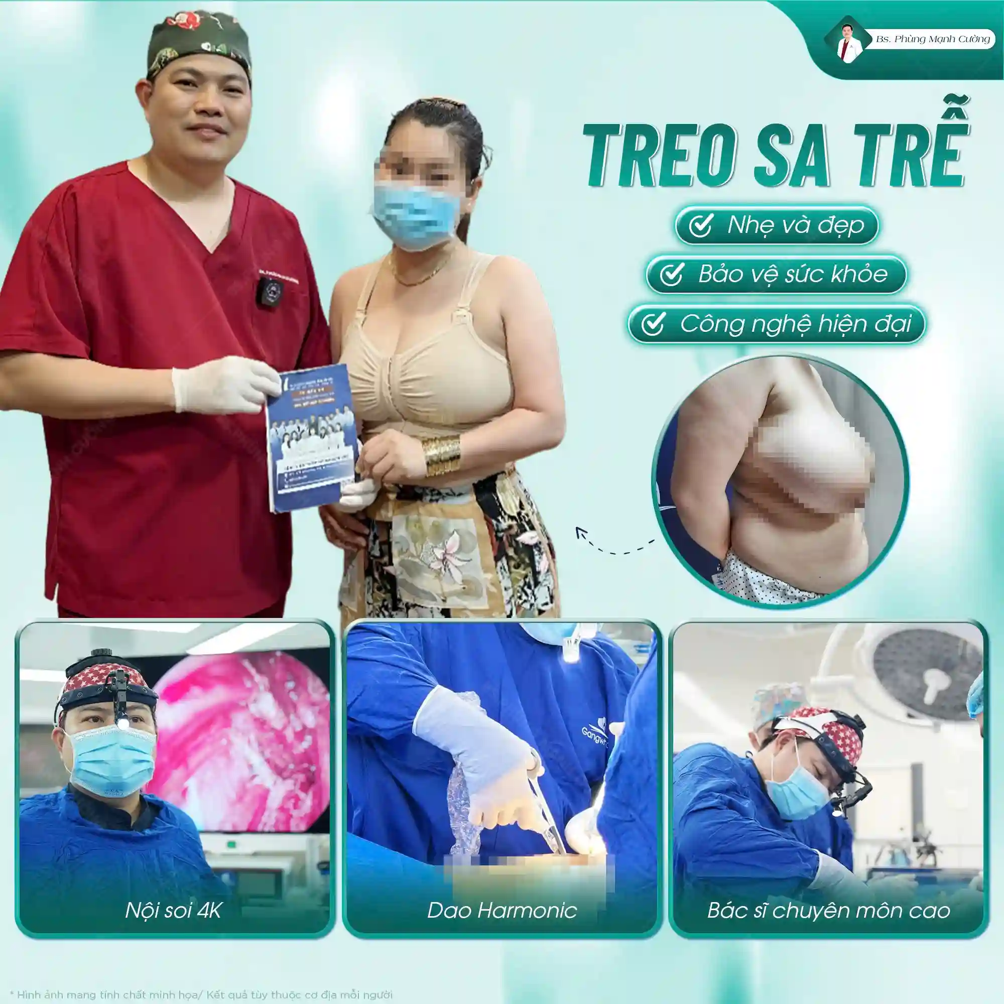 Treo ngực sa trễ cấp độ 2 tại bác sĩ Phùng Mạnh Cường
