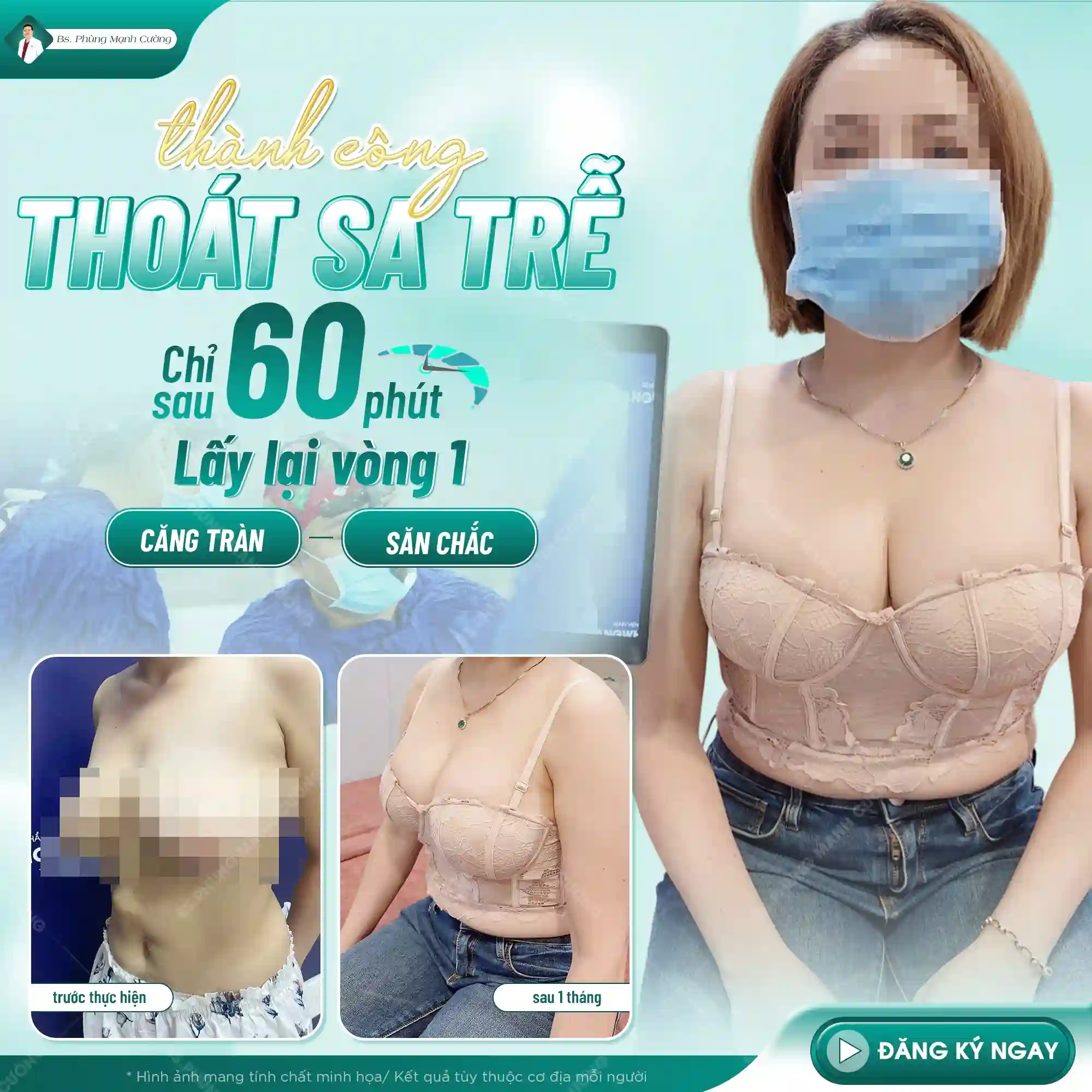 Treo Ngực Sa Trễ Là Gì? Những Ai Nên Thực Hiện?