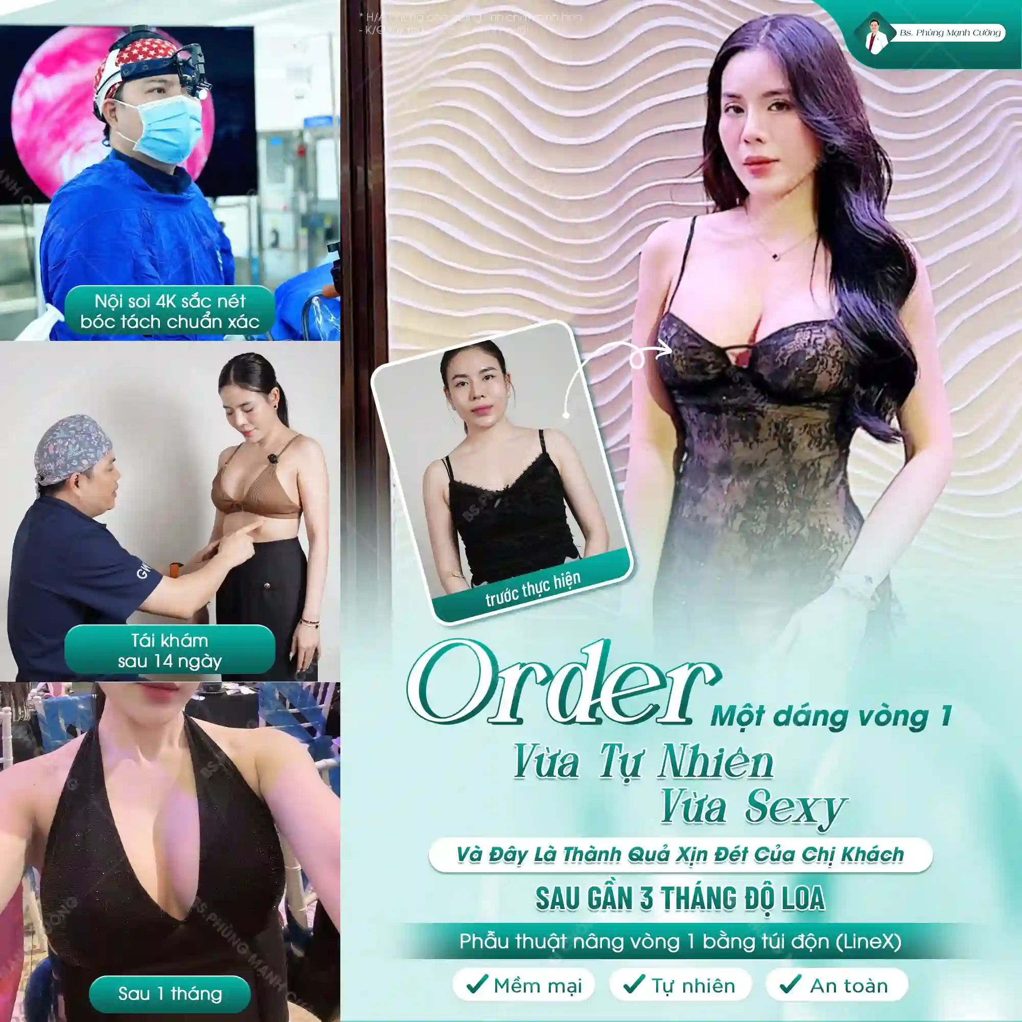 Treo ngực qua đường mổ dọc là phương pháp được áp dụng khi ngực sa trễ cấp độ 2