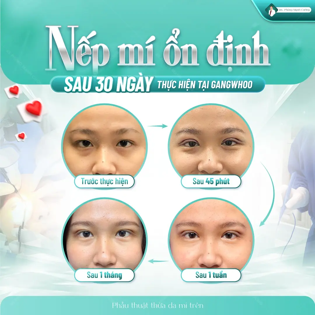 Thông thường, nếp mí sẽ đẹp tự nhiên sau khoảng 2–3 tuần