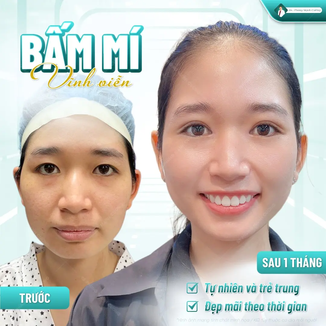 Mức giá dịch vụ bấm mí vĩnh viễn dao động từ 7 đến 10 triệu đồng