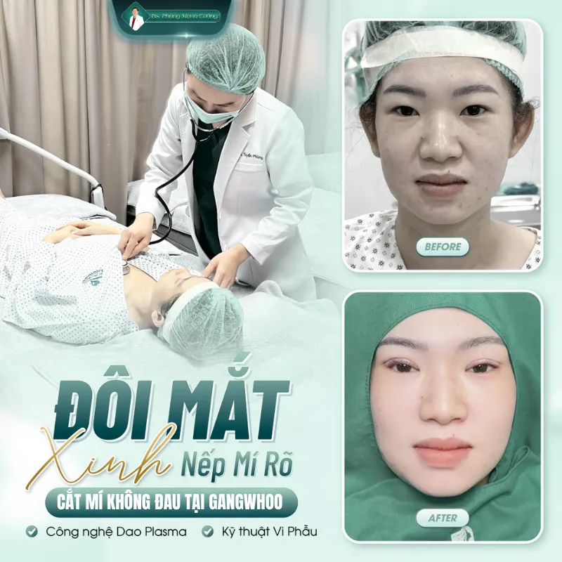 Cắt mí có đau không? Bác sĩ giải đáp quy trình an toàn 12 Lưu ý khi cắt mí để đảm bảo an toàn và không đau