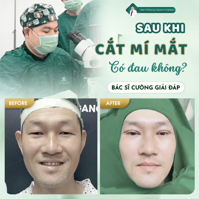 Cắt mí có đau không? Bác sĩ giải đáp quy trình an toàn 9 Cắt Mí Mắt Có Đau Không? Giải Đáp Chi Tiết Từ Bác Sĩ